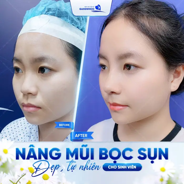 Đừng Bỏ Lỡ! 4 Cơ Sở Nâng Mũi Ở Quảng Bình Uy Tín, Chất Lượng