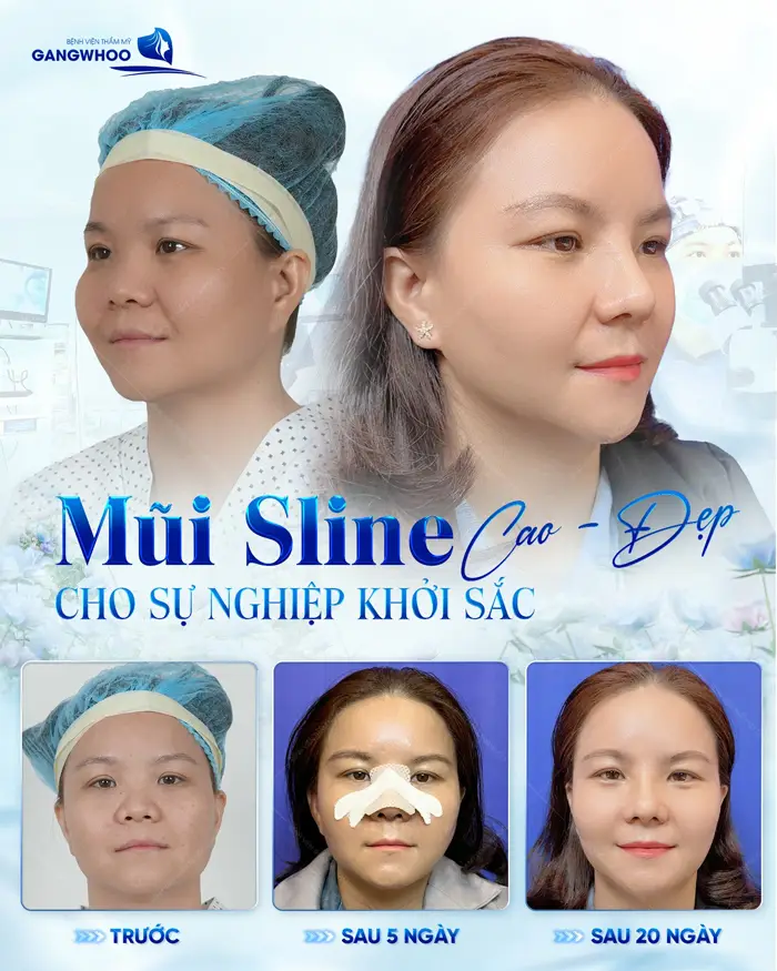 Top 4 Địa Chỉ Nâng Mũi Ở Quảng Trị Giúp Bạn Lột Xác Ngoạn Mục