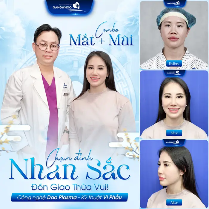 Nhan sắc chạm đỉnh thăng hạng diện mạo mới khi khách hàng lựa chọn nâng mũi tại Gangwhoo