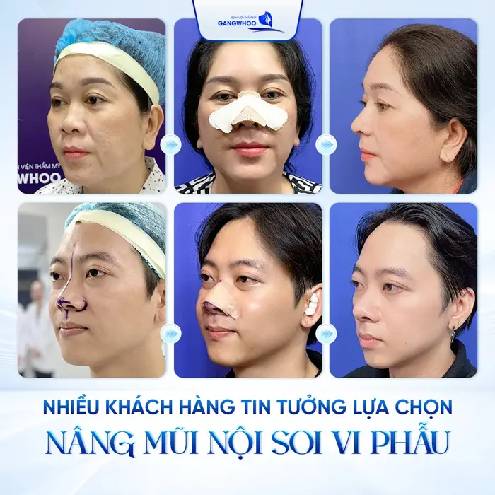 Nhiều khách hàng tin tưởng lựa chọn nâng mũi nội soi vi phẫu tại Gangwhoo vì kết quả an toàn và đẹp tự nhiên