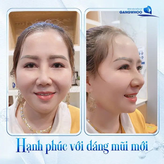 Khách hàng hạnh phúc với dáng mũi mới sau phẫu thuật nâng mũi