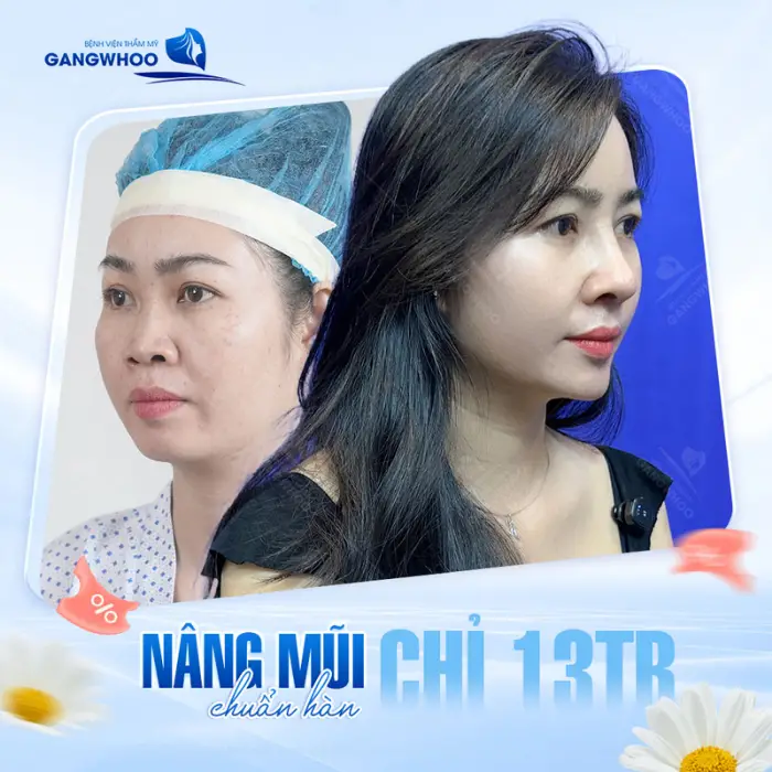 Dáng mũi chuẩn Hàn sau khi thực hiện nâng mũi