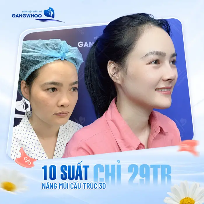 Hình ảnh khách hàng sau nâng mũi Hàn Quốc
