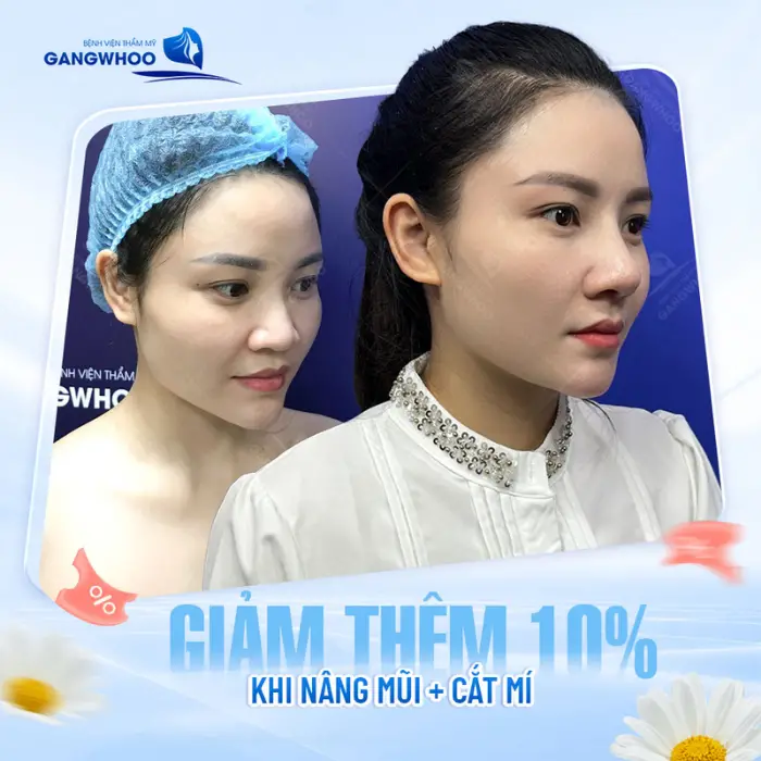 Dáng mũi mềm mại và tự nhiên đúng chuẩn nâng mũi Hàn
