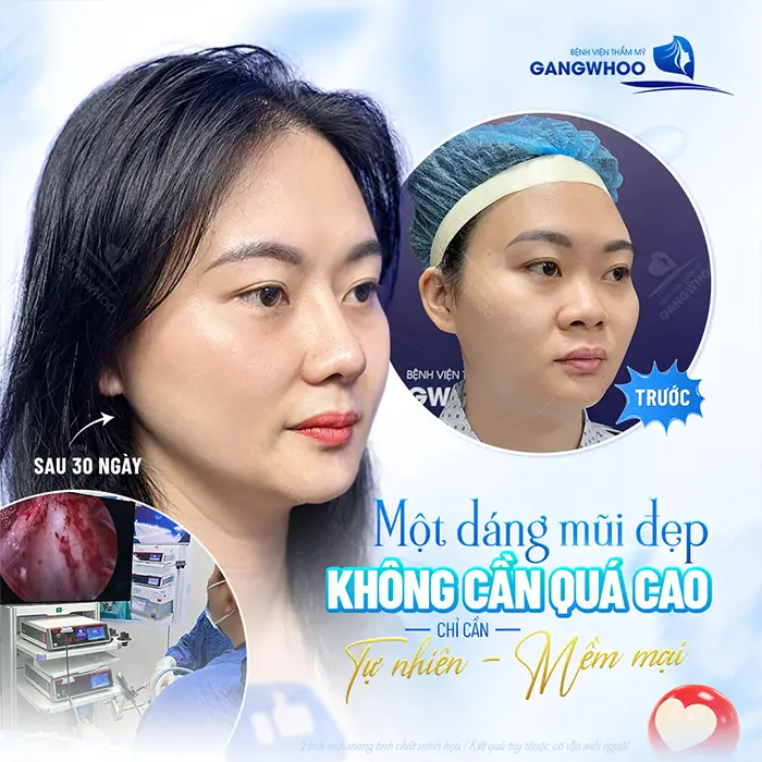 Nâng mũi high line được bao lâu? Có vĩnh viễn không?