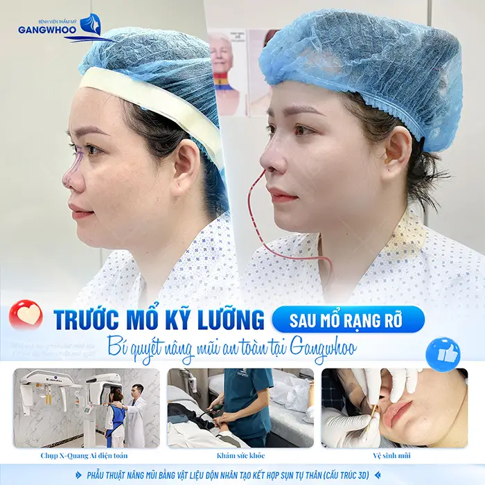 Nâng mũi megaderm: Ưu điểm và quy trình thực hiện