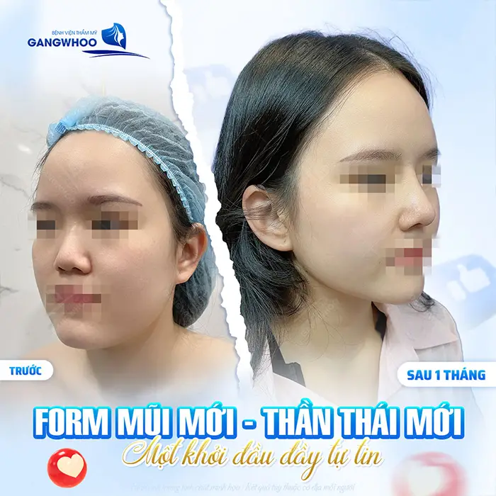 Nâng mũi megaderm: Ưu điểm và quy trình thực hiện