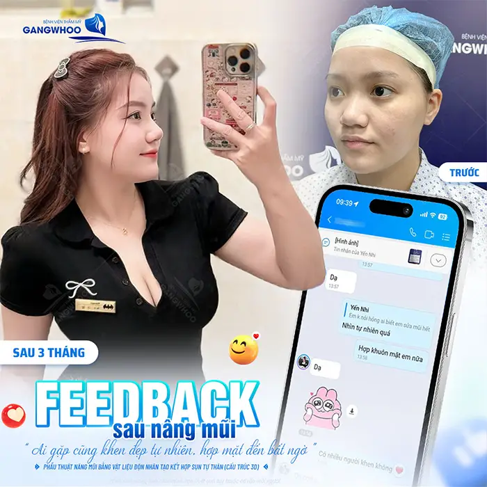 Nâng mũi megaderm: Ưu điểm và quy trình thực hiện