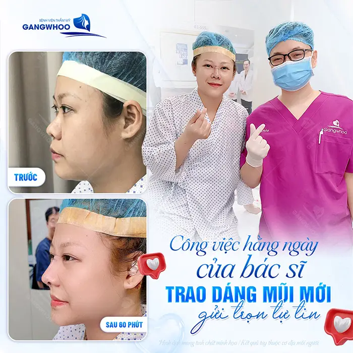Nâng mũi megaderm: Ưu điểm và quy trình thực hiện