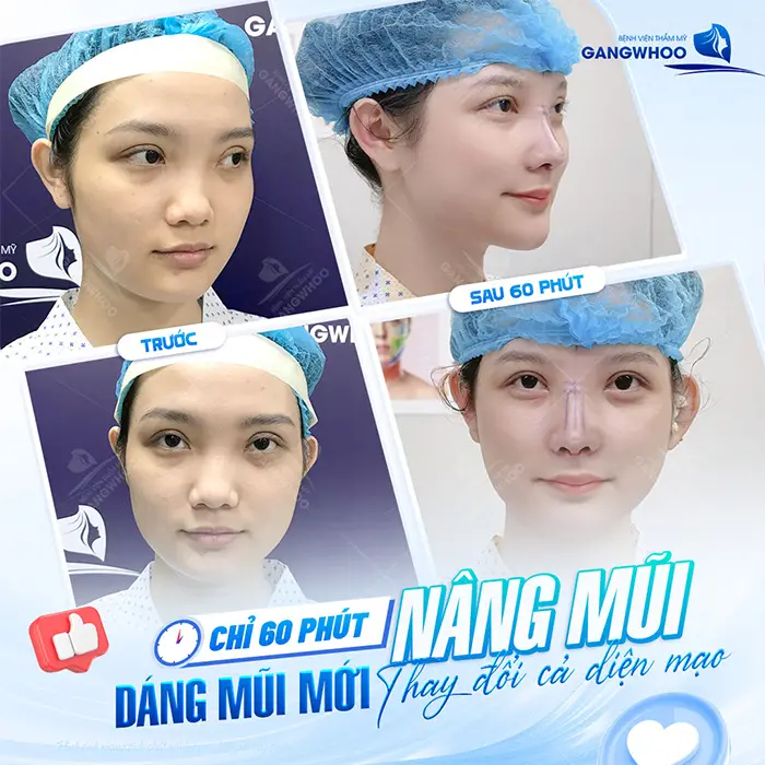 Nâng mũi megaderm: Ưu điểm và quy trình thực hiện