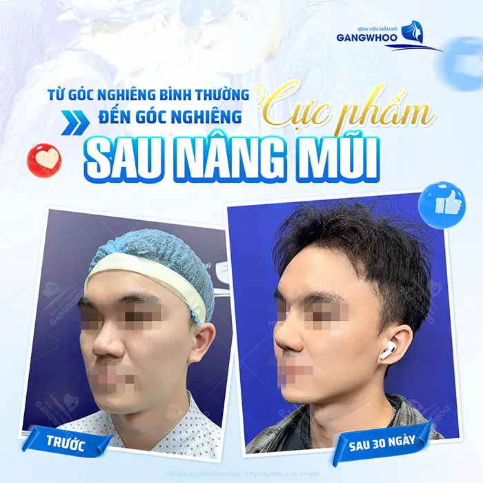 Nâng mũi megaderm: Ưu điểm và quy trình thực hiện