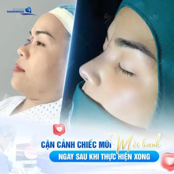 Kết quả khách hàng sau khi nâng mũi sụn sườn