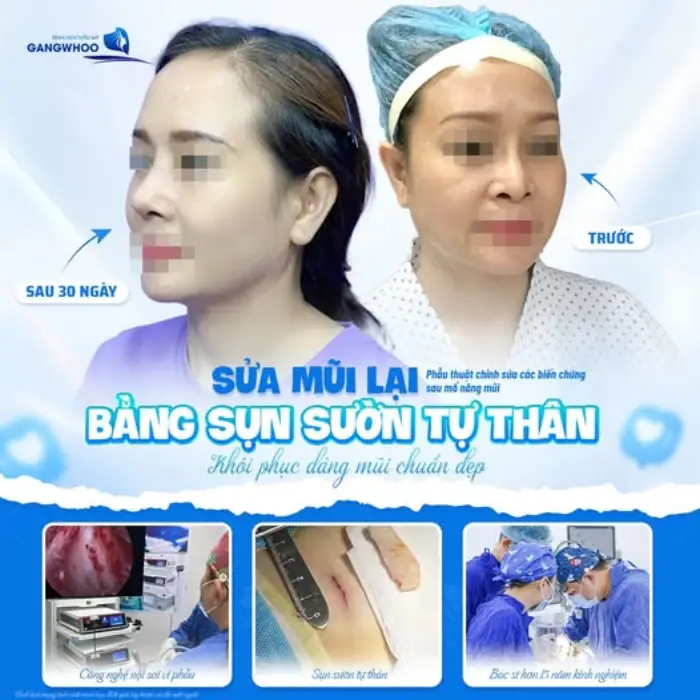 Kết quả nâng mũi sụn sườn – dáng mũi cao tự nhiên và chắc chắn
