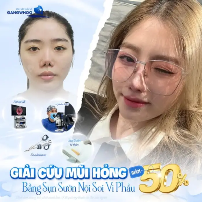 Trước – sau nâng mũi sụn sườn: cải thiện đáng kể chiều cao và độ dài mũi