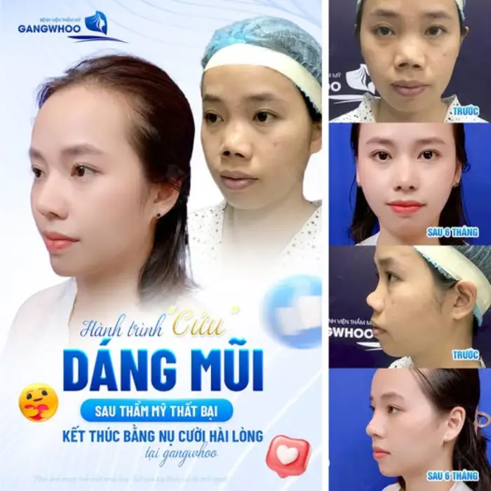 Hình ảnh thực tế nâng mũi sụn sườn: đầu mũi gọn, sống mũi cao thanh thoát