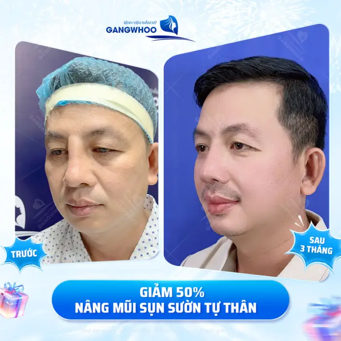 Nâng mũi sụn sườn cho kết quả tự nhiên, phù hợp với cấu trúc từng gương mặt.