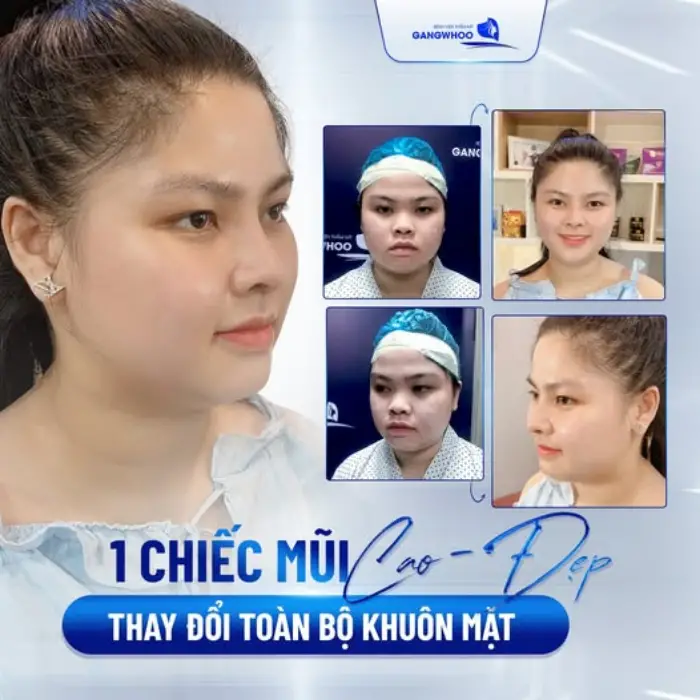 Sự thay đổi của mũi qua các giai đoạn hồi phục sau nâng sụn tai