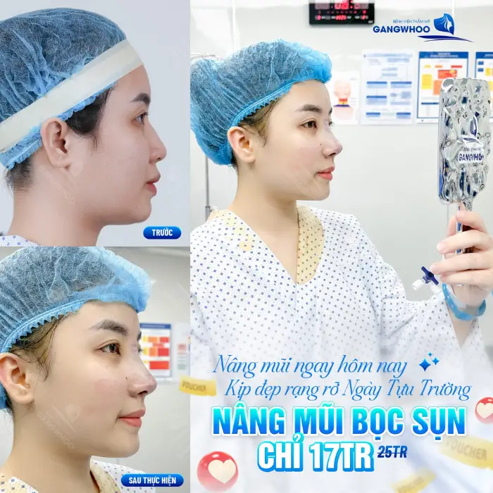 Nâng mũi sụn tai mang lại đầu mũi tròn đẹp, tự nhiên