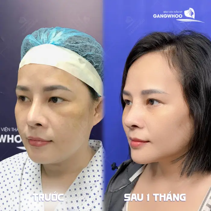 Kết quả nâng mũi sụn tai cho đầu mũi mềm mại và tự nhiên