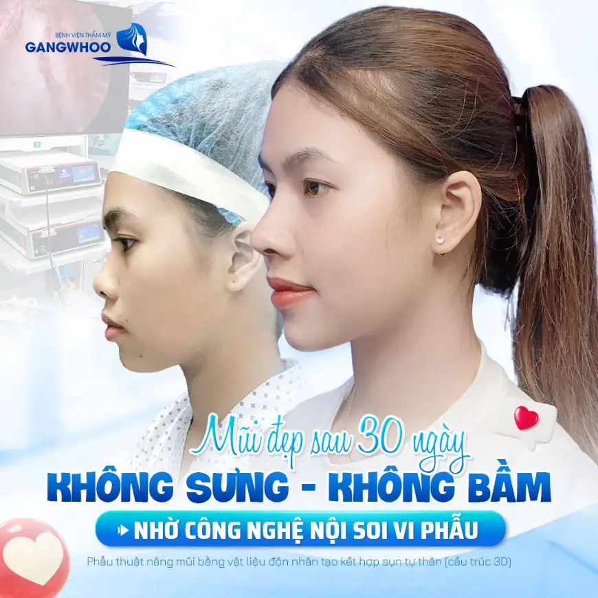Kết quả của khách hàng sau 30 ngày nâng mũi cấu trúc 3D