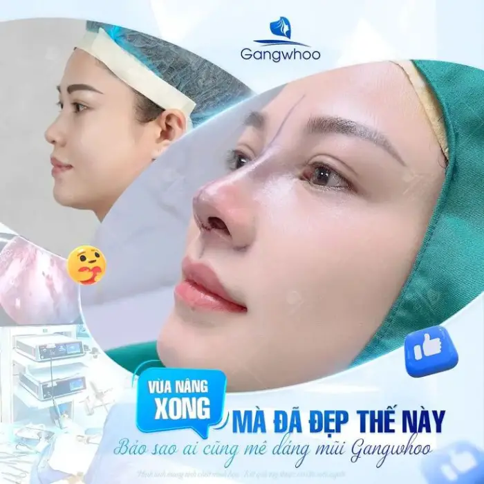 Trước – sau nâng mũi an toàn tự nhiên mũi thanh thoát