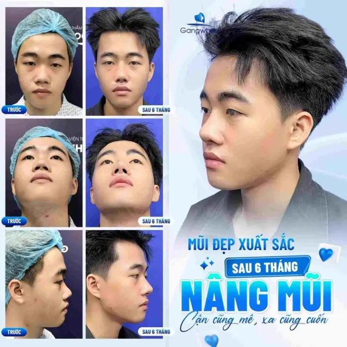 Dáng mũi nam giới sau nâng – đường nét mạnh mẽ, góc nghiêng rõ