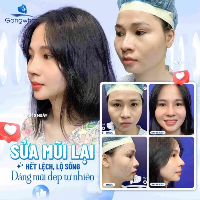 Dáng mũi sau nâng mũi an toàn tự nhiên – mềm, gọn và cân đối khuôn mặt