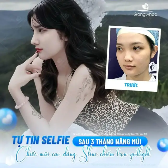 Nâng mũi an toàn tự nhiên với dáng cong tinh tế, phù hợp gương mặt Á Đông