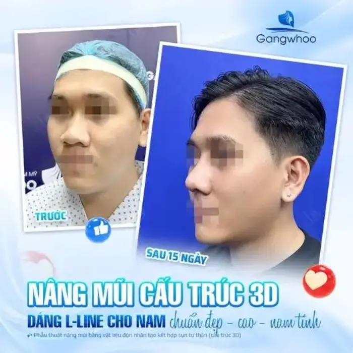 Trước – sau nâng mũi nam: mũi thẳng, phù hợp cấu trúc gương mặt nam tính