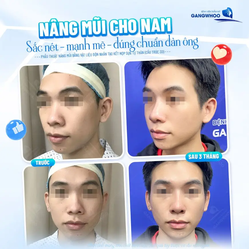 Phẩu thuật nâng mũi cấu trúc 3D